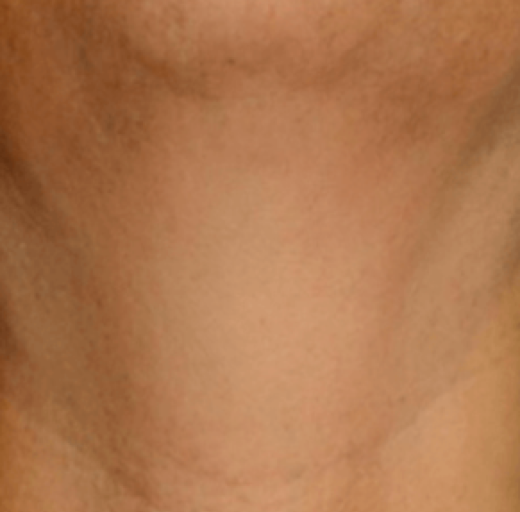 Before/After Image